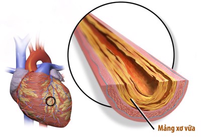 Bệnh mạch vành: 7 thông tin cần biết để tránh nhồi máu cơ tim